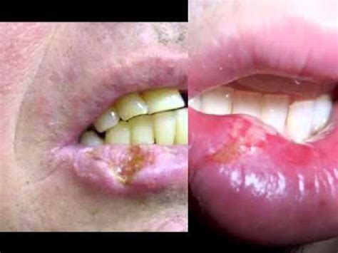 Lip Cancer Pictures   YouTube