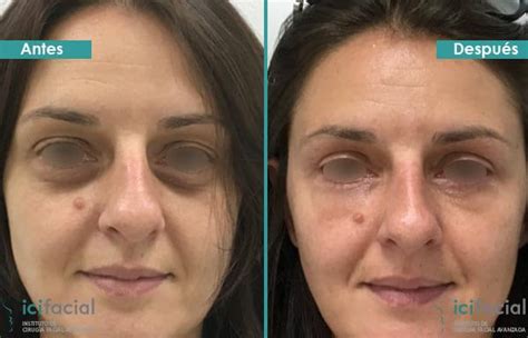 Lipofilling facial antes y después en Madrid   Pacientes ...