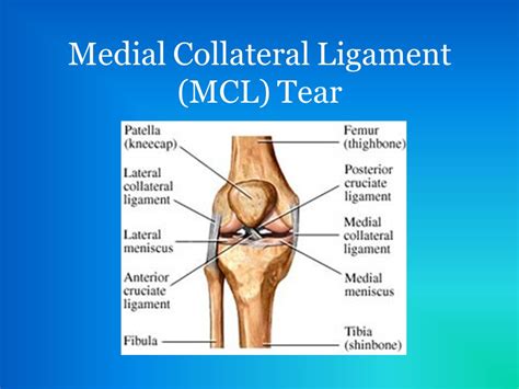 List of Synonyms and Antonyms of the Word: mcl ligament