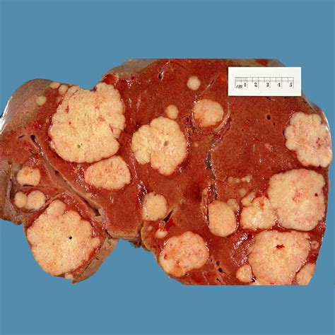 Liver metastases: gross pathology | Image | Radiopaedia.org