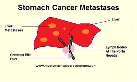 Liver Metastases In Stomach Cancer