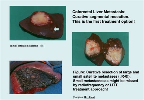 Liver Metastases – Colon and Rectal Cancer Surgery
