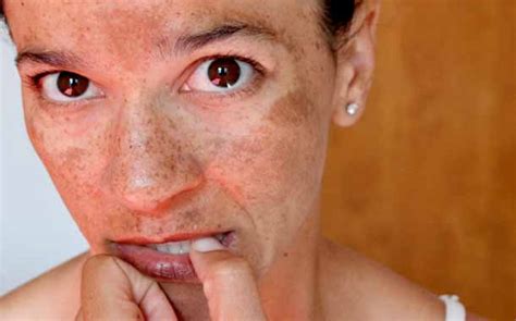 Lo qué necesitas saber sobre las manchas en la cara
