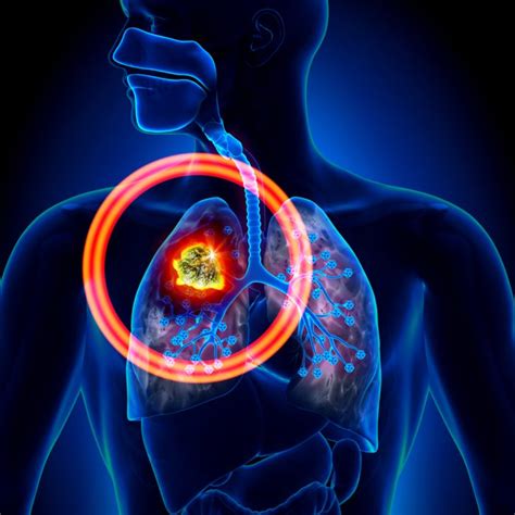Los 8 Síntomas del cáncer de pulmón a los que debes estar ...