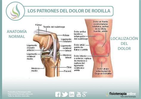 Los patrones del dolor de rodilla o gonalgia y las ...