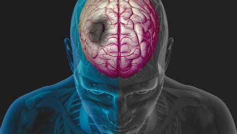 Los “Avisos” del Infarto Cerebral | Clí­nica Neuron
