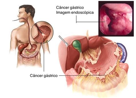 Los síntomas del cáncer de estómago ¡ALERTA!