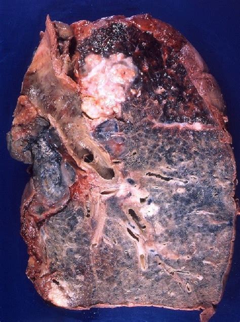 Los síntomas del cáncer de pulmón   Demedicina.com