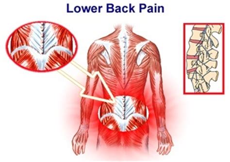 Low Back Pain | Arizona Pain Specialists   Phoenix ...