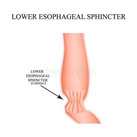 Lower Cardiac Esophageal Sphincter. Infographics. Vector ...