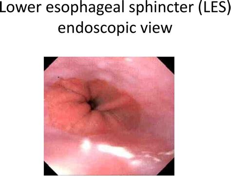 Lower Esophageal Sphincter Endoscopy | www.imgkid.com ...