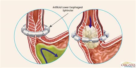 Lower Esophageal Sphincter Endoscopy | www.imgkid.com ...