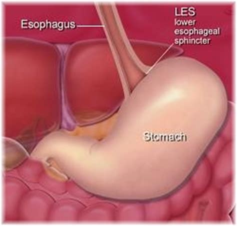 Lower Esophageal Sphincter   What Is The Lower Esophageal ...