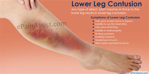 Lower Leg Contusion|Symptoms|Treatment|Stretching ...
