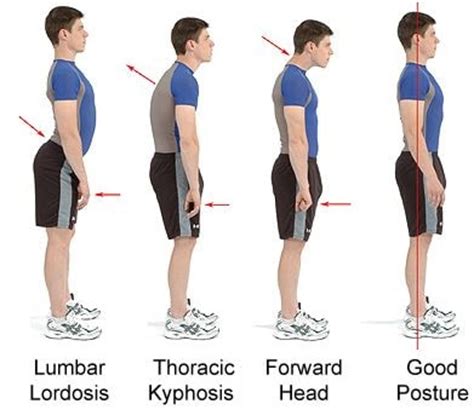 Lumbar Lordosis   Exercises, How to Fix, Treatment, What is
