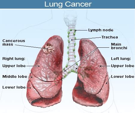 Lung Cancer   Causes, Symptoms, Treatment, Stages ...
