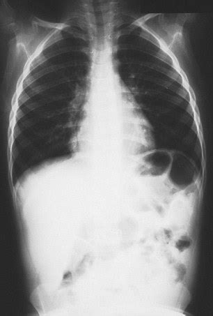 Lung cancer is diagnosed far too late in the UK | Daily ...
