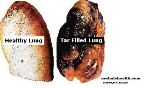 Lung Cancer Stage 4 Weight Loss