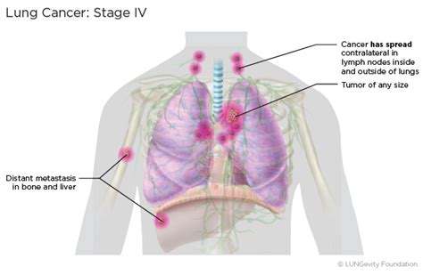 Lung Cancer Staging | LUNGevity Foundation