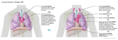 Lung Cancer Staging | LUNGevity Foundation