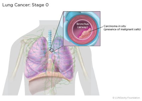 Lung Cancer Staging | LUNGevity Foundation