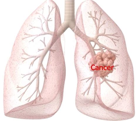 Lung Cancer: Symptoms of Lungs Cancer