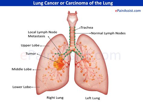 Lung Cancer: Treatment, Causes, Symptoms, Risk Factors, Stages