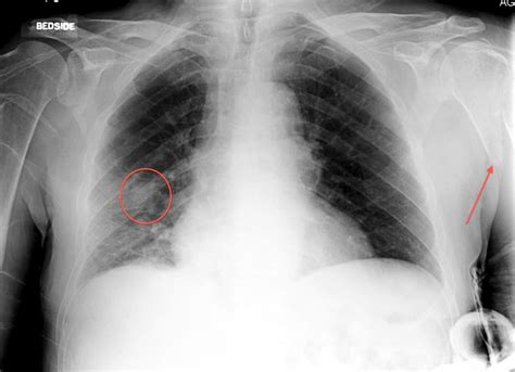 Lung cancer with bone metastasis Radiology at St ...