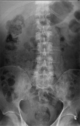 Lung carcinoma with vertebral metastasis | Image ...