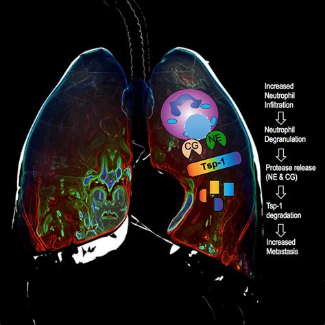 Lung inflammation contributes to metastasis