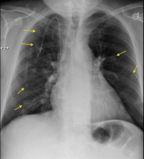 Lung metastases, portacath   Radiology at St. Vincent s ...