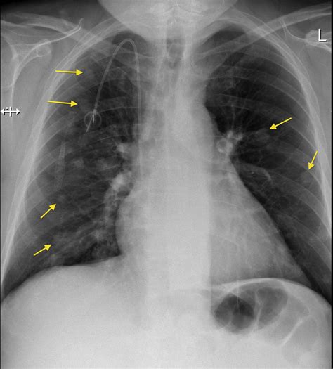 Lung metastases, portacath Radiology at St. Vincent s ...