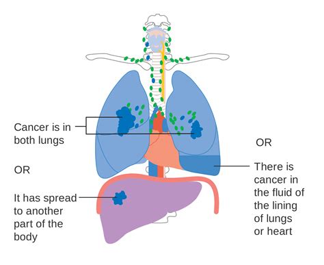 Lung neoplasms; Pulmonary Neoplasms; Cancer of Lung; Lung ...