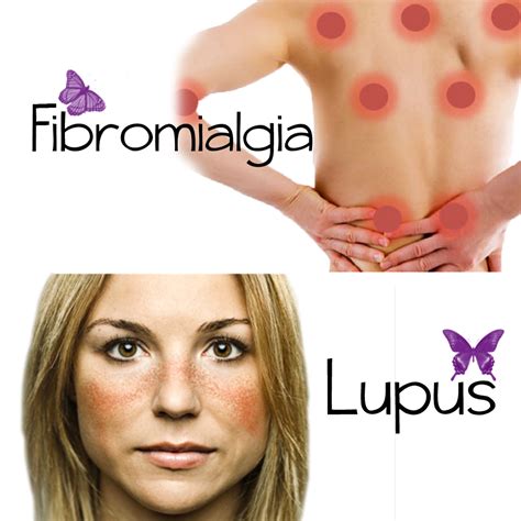 Lupus y Fibromialgia: similitudes y diferencias ...
