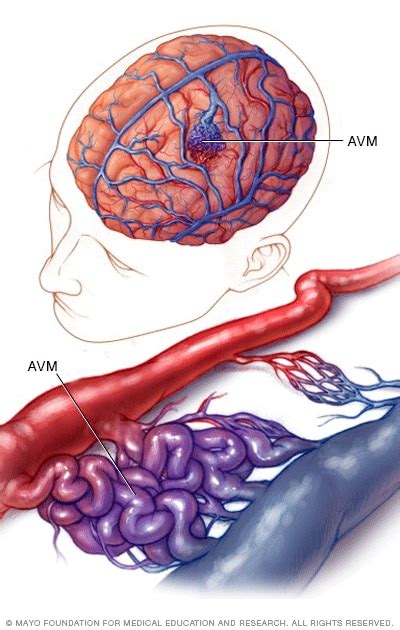 Malformación arteriovenosa cerebral   Síntomas y causas ...