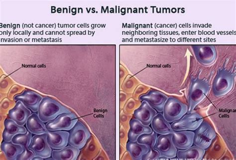 Malignant: Benign And Malignant Tumors Difference