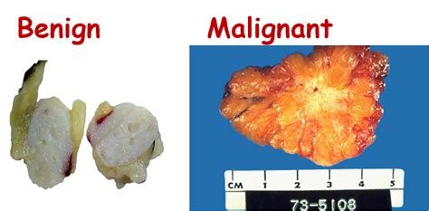 Malignant: Benign Vs Malignant Tumors