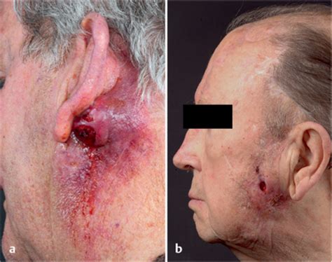 Malignant Head and Neck Tumors and Skin Cancer ...