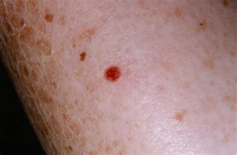 Malignant Melanoma   Pictures, posters, news and videos on ...