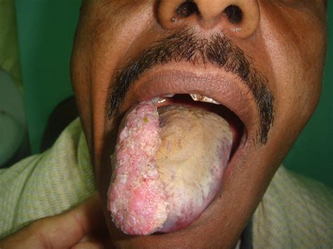 malignant tumor of the tongue | Abotammam11 s Photo