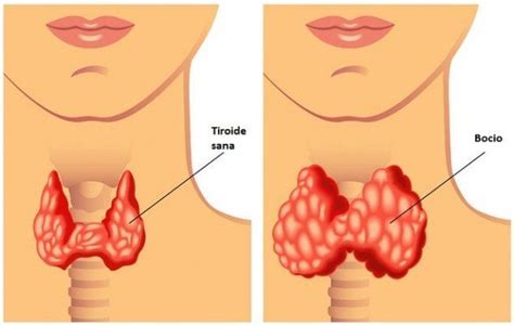 Malos hábitos que alteran la salud de tu tiroides