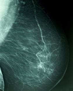 Mamografía después de aumento de pecho   BonomédicoBlog