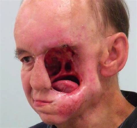 Man Who Lost His Face To Nose Cancer Gets His Face Back