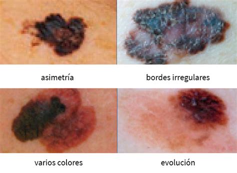 Manchas y melanoma: todo lo que debes saber para revisar ...