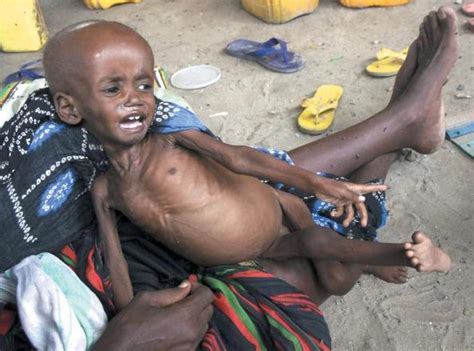 Más de 29 mil niños somalíes murieron desnutridos