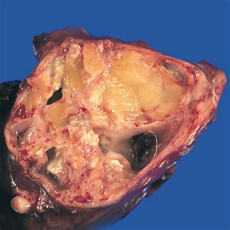 Mature mediastinal teratoma   gross pathology | Image ...
