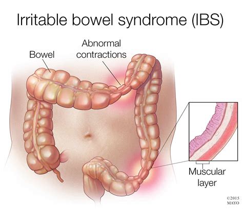Mayo Clinic Q and A: For most diagnosed with it, IBS is a ...