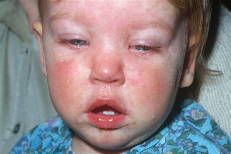 Measles, Mumps & Rubella