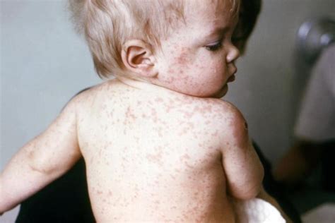 Measles, Mumps, Rubella Vaccine