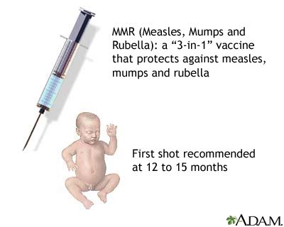 Measles, mumps, rubella vaccine | UF Health, University of ...